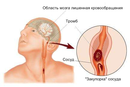 Infarctul (accident vascular cerebral), simptome cerebrale și efecte