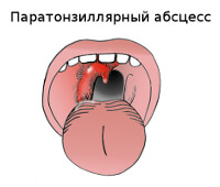 Simptomele și tratamentul abces peritonsilar