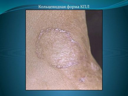 Lichen planus (foto) - cauze, diagnostic și tratament