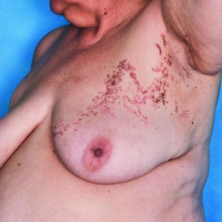 Lichen planus (foto) - cauze, diagnostic și tratament