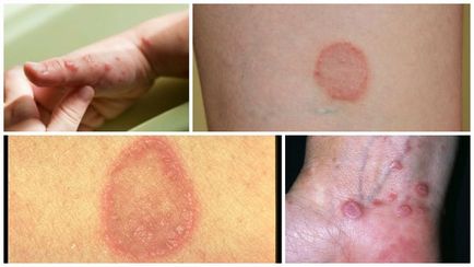 Lichen planus (foto) - cauze, diagnostic și tratament