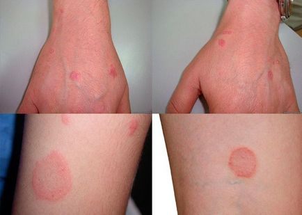 Lichen planus (foto) - cauze, diagnostic și tratament