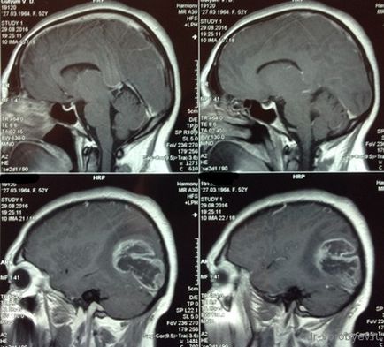 astrocitom anaplazic, neurochirurgie