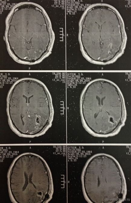 astrocitom anaplazic, neurochirurgie