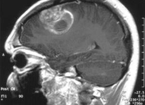 Și difuze creier astrocitom anaplazic - Tratament si prognostic