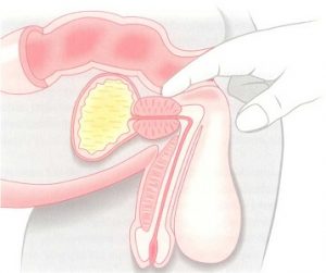 a prosztata urethral resekciója prostatitis 3 hét