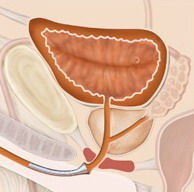 Strictura uretral, urolog meu