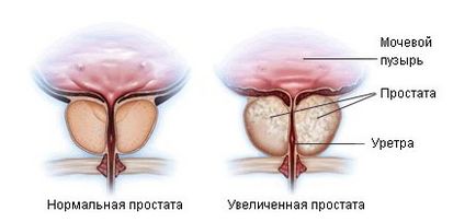 focar de fibroză cu prostatită
