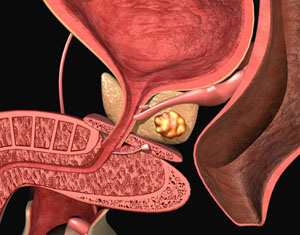 Modificări fibrotice ale prostatitei