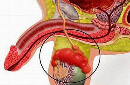 Tuberculoza a rinichilor - Simptome, cauze, diagnostic, posibilele complicatii si prevenirea