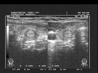 Diagnostic cu ultrasunete tiroiditei autoimune cronice