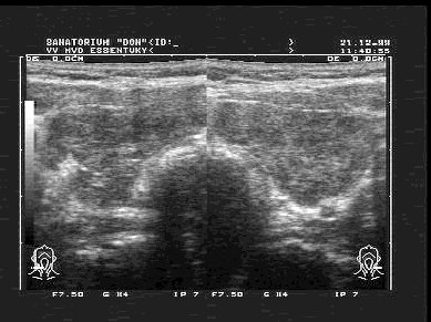 Diagnostic cu ultrasunete tiroiditei autoimune cronice