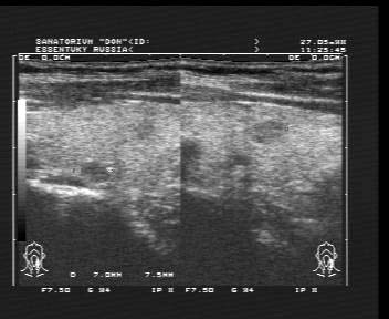 Diagnostic cu ultrasunete tiroiditei autoimune cronice