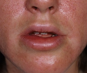 Angioedema - okok, tünetek, kezelés, megelőzés, fotók