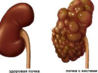 Boala lui Ormond (fibroza retroperitoneală), ceea ce este, de tratament, dieta