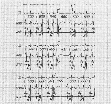 Focal (ectopiás) pitvari tachycardia