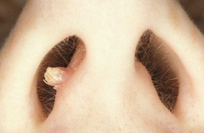 Papilom în nas cum să eliminați Papilloma virus cure uomo