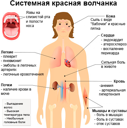 lupus eritematos sistemic la copii și simptomele bolii Imagine