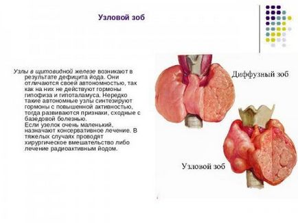 gusa nodulara tratamentului glandei tiroide, simptomele și amploarea bolii