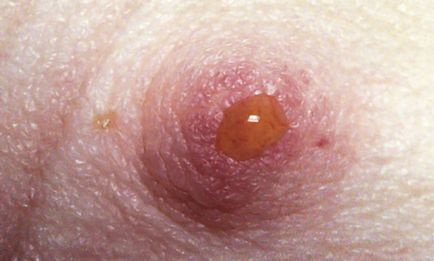 Afecțiunile mamare care nu sunt cancer Papilom intraductal mamar