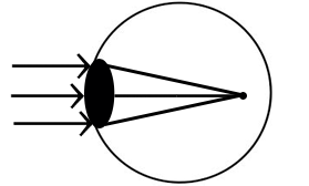 Lunettes sténopé - Pouvez-vous améliorer Vision avec sténopé Lunettes (améliorer) Lunettes sténopé - Pouvez-vous améliorer Vision avec sténopé Lunettes