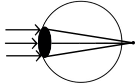 Lunettes sténopé - Pouvez-vous améliorer Vision avec sténopé Lunettes (améliorer) Lunettes sténopé - Pouvez-vous améliorer Vision avec sténopé Lunettes