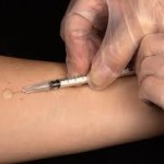 Test de tuberculine cutané positif et des résultats négatifs de test cutané à la tuberculine (positif) Test cutané à la tuberculine Résultats positifs et négatifs du test cutané à la tuberculine