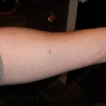 Test cutané positif à la tuberculine et des résultats négatifs de test cutané à la tuberculine (test) Test cutané à la tuberculine Résultats positifs et négatifs du test cutané à la tuberculine