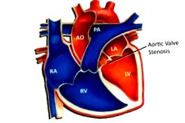 aortică