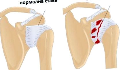 osteoartrita