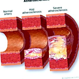 riscul ateroscleroză