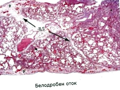 edemului pulmonar