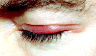 blefarita nu afectează vederea