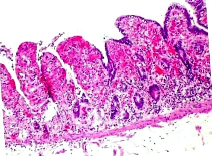 peretelui intestinal