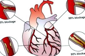 Boală cardiacă