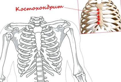 costocondrita