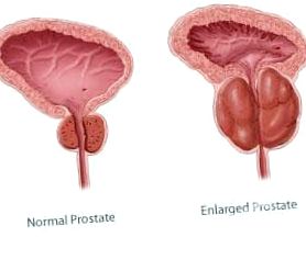 prostată