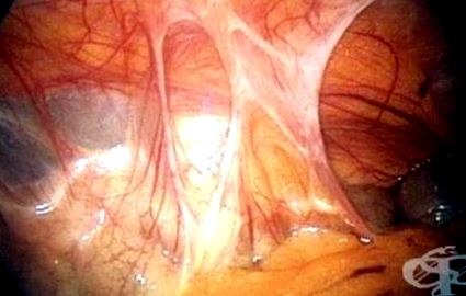 Aderențele peritoneale