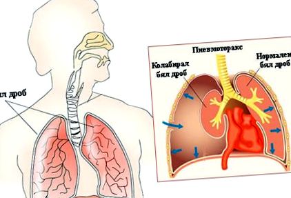 pneumothorax levegő