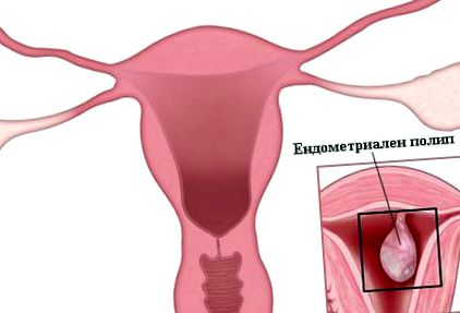 endometriali