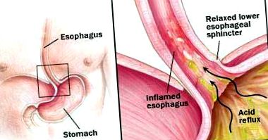 esofagită
