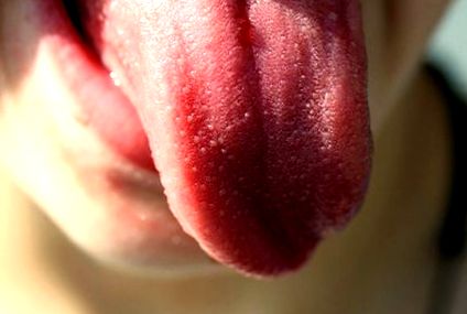 inflamație limbii