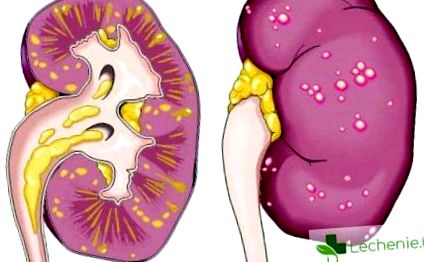 Pielonefrita (infectie la rinichi) – Cauze, factori de risc si tratament