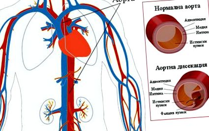 aorta disszekciójának