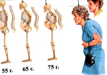 Osteoporoză primară