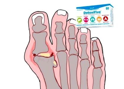 Totul despre artrita genunchiului - Simptome, tipuri, tratament | auto-motorhitel.hu
