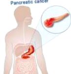 cancerul pancreatic