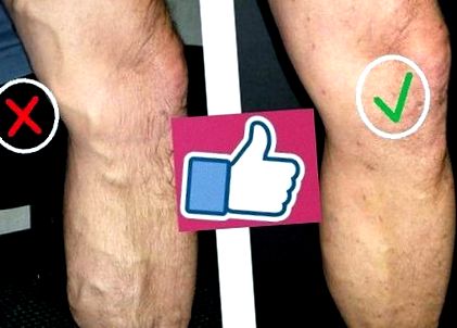 Picioare Venele Vindeca - Cum se tratează gimnastica varicoasă