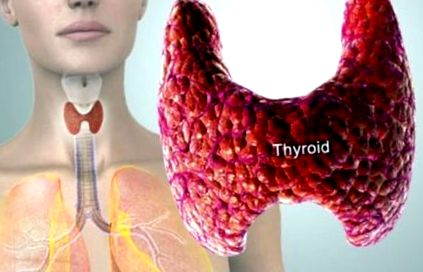 tiroidita