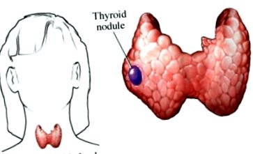 glandei tiroide